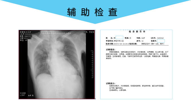 脑出血护理个案分析PPT模板