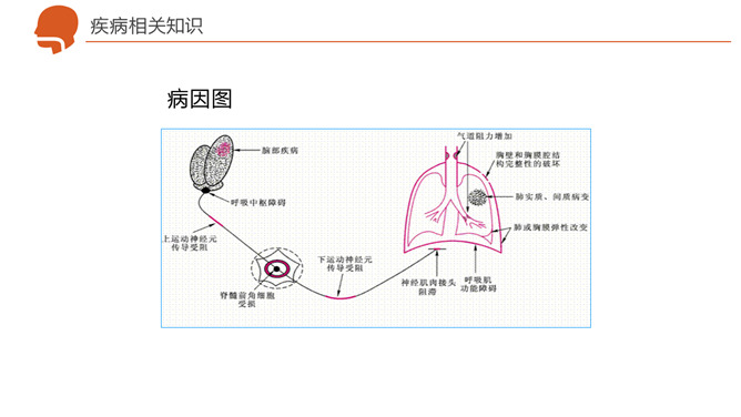 呼吸衰竭护理治疗病例分析PPT模板